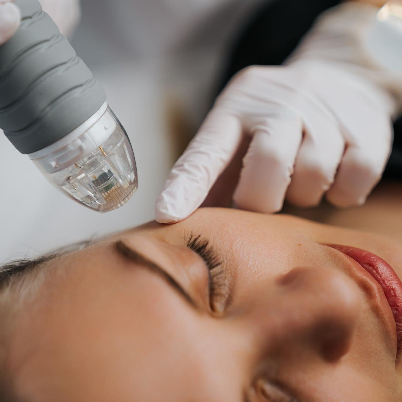 RF Microneedling