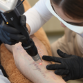 Tattoo Removal