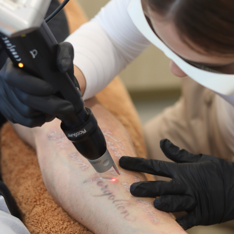 Tattoo Removal